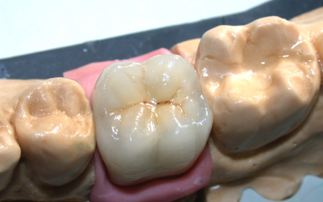 Metallo ceramica