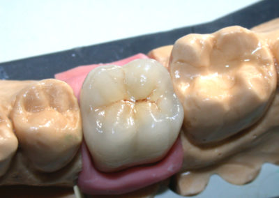 Metallo ceramica
