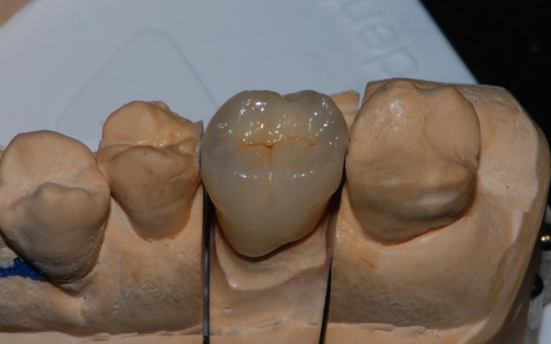 Zirconio (Caso 3)