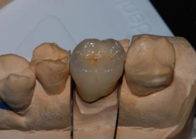 Zirconio (Caso 3)