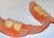 Protesi Finite su Modello