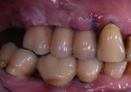 Provvisori Carico Immediato (Caso 2)