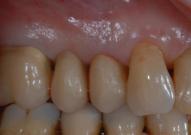 Provvisori Carico Immediato (Caso 3)