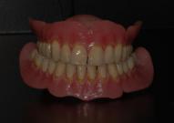 Protesi Mobile (Caso 2)